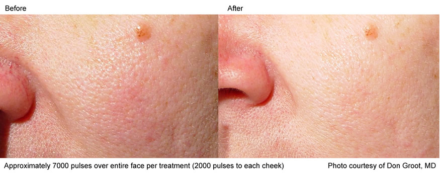 Laser Skin Rejuvenation - Laser Genesis Treatment