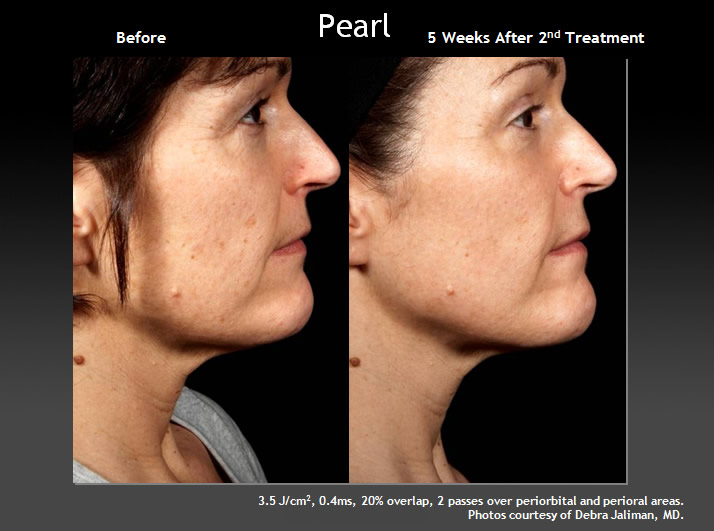 Pearl Laser Facial for Age Management