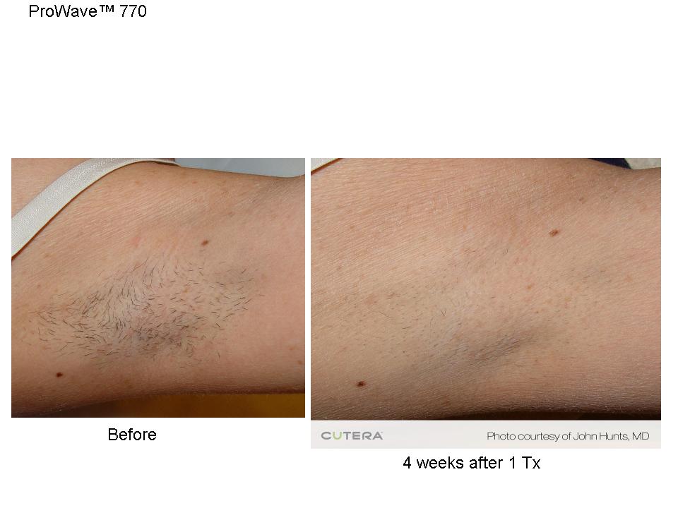 Laser Hair Removal in Wilmington NC