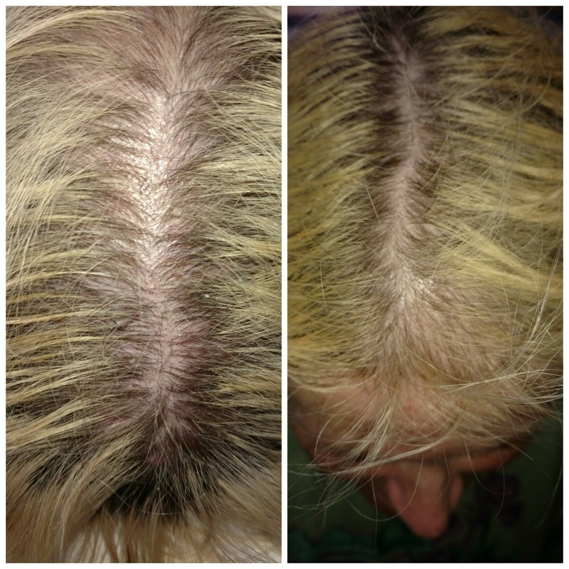 PRP for hair Loss Wilmington NC